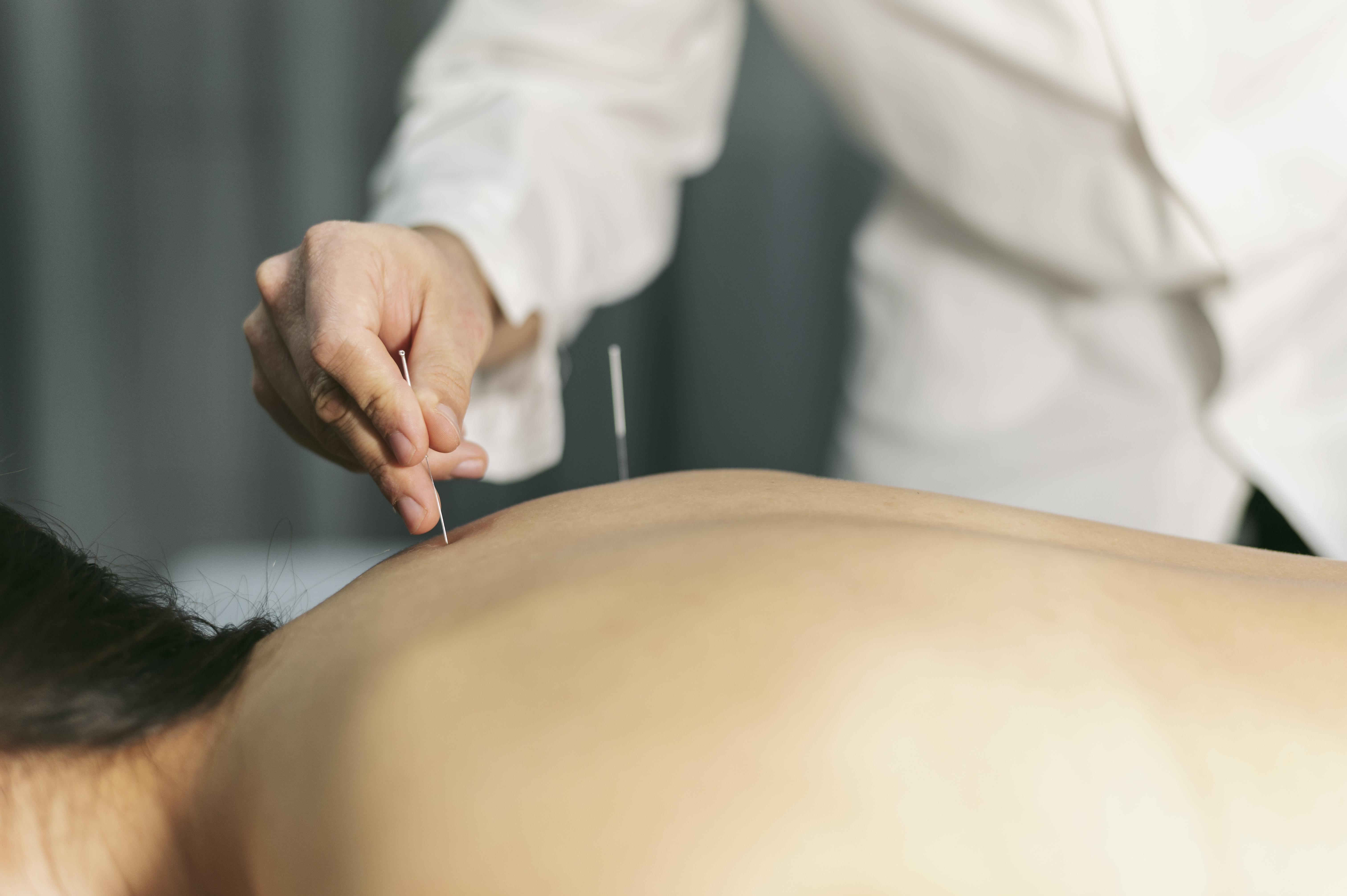 Acupuncture session 